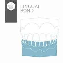 INDIVIDUA Lingual Bond UK